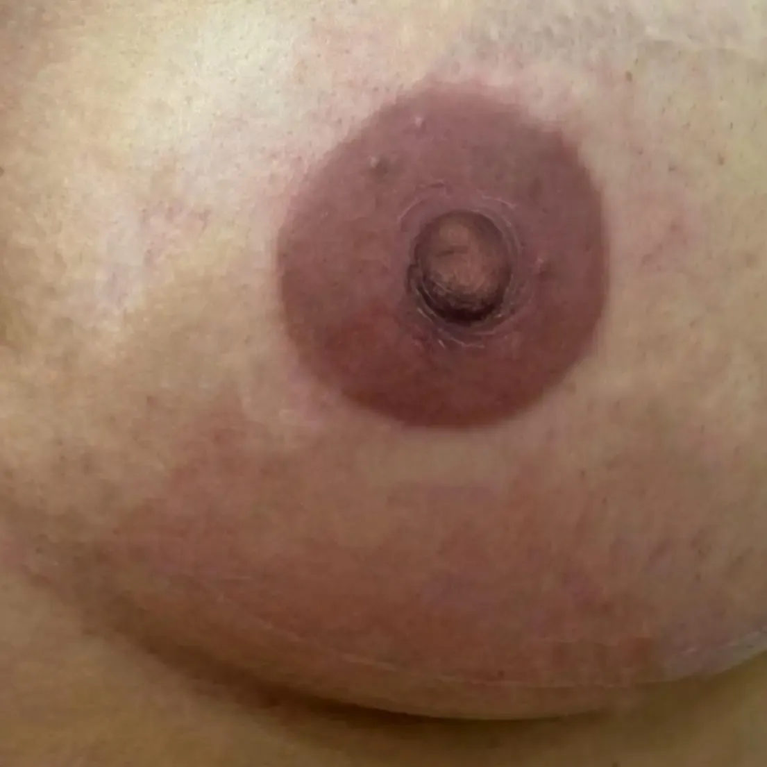 Foto del trattamento Ricostruzione areola mammaria