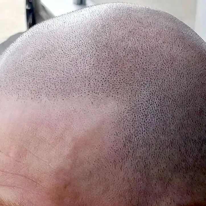 Foto del trattamento Tricopigmentazione